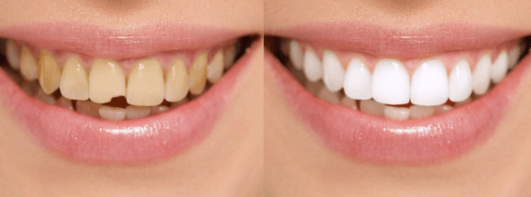 Композитная реставрация зубов 